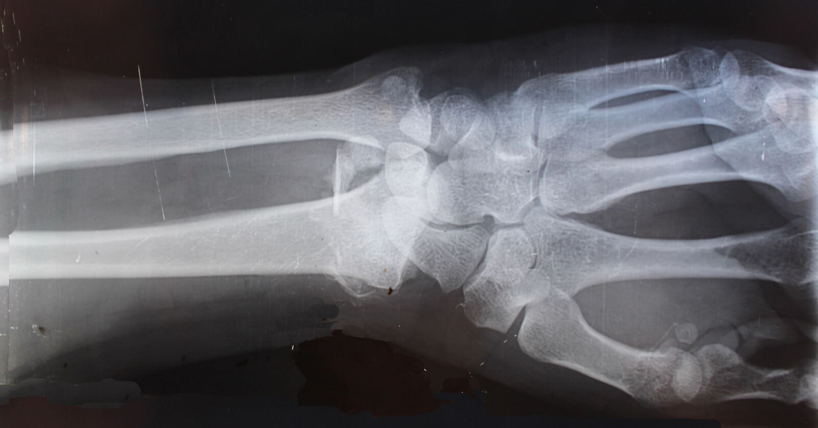 PERSONAL INJURY PERSONAL INJURY